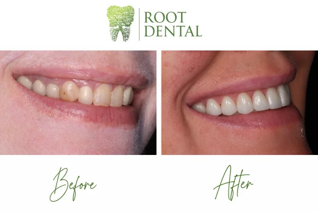 Porcelain veneers dental treatment result