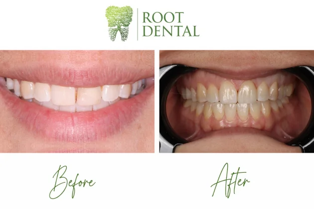 Same-Day Composite Restoration