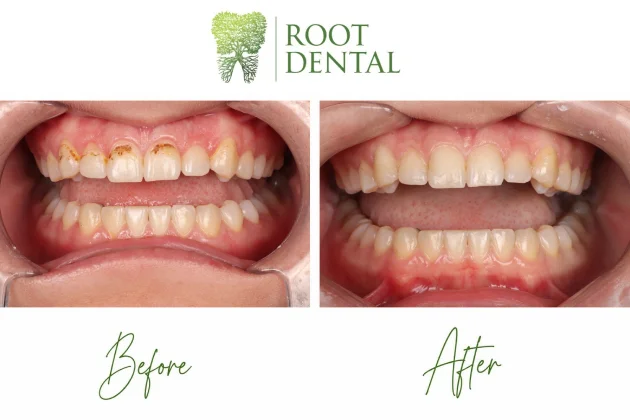 Smile Restoration