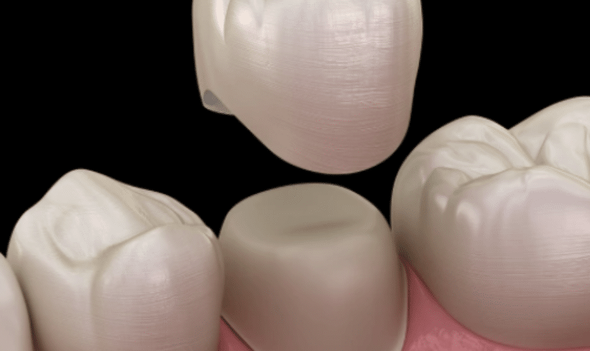 A close-up of dentist showing dental crowns to a patient at Rugby Dental Arts in Charlottesville