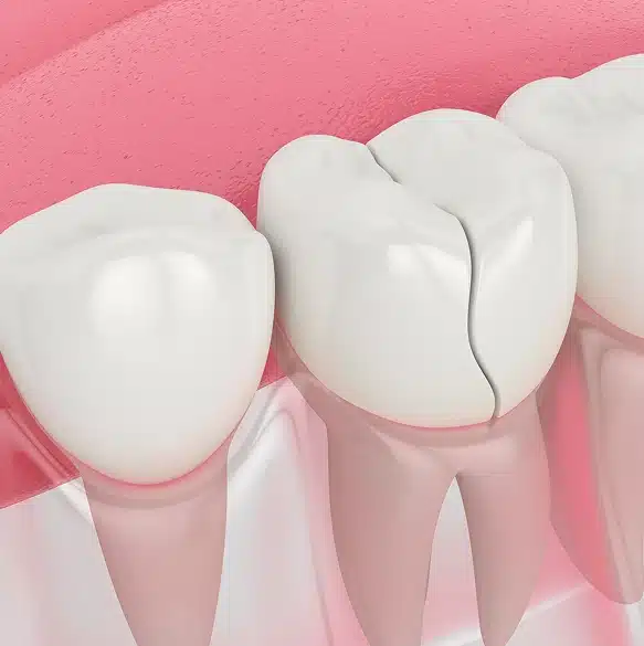 Fast, Reliable Chipped Tooth Repair