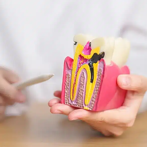 Root Canal Treatment in Rock Hill, SC