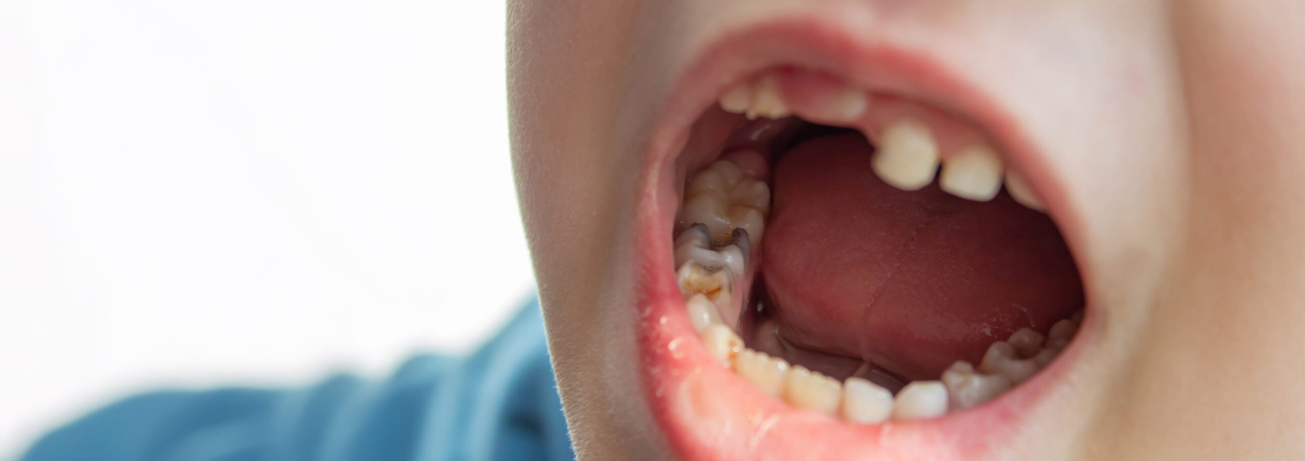 Dental Sealants for Kids