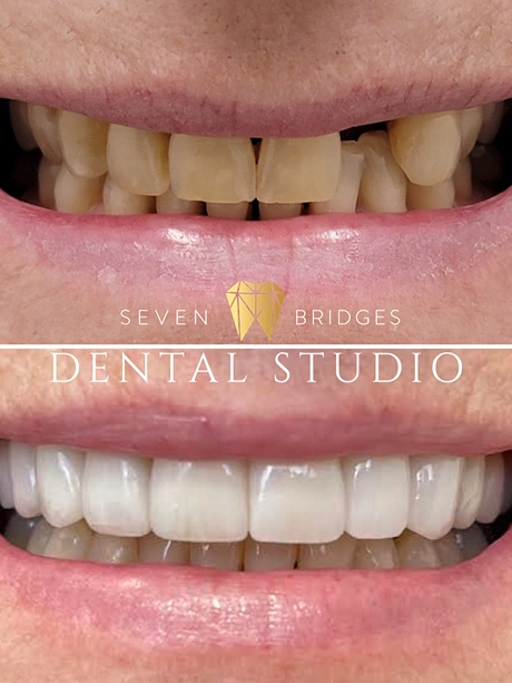 Before and after dental treatment results showcasing a brighter and more balanced smile