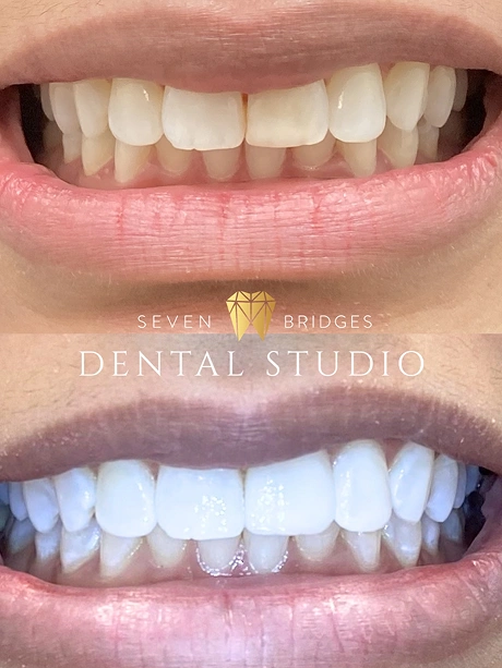Before and after smile transformation showing improved tooth shape and appearance