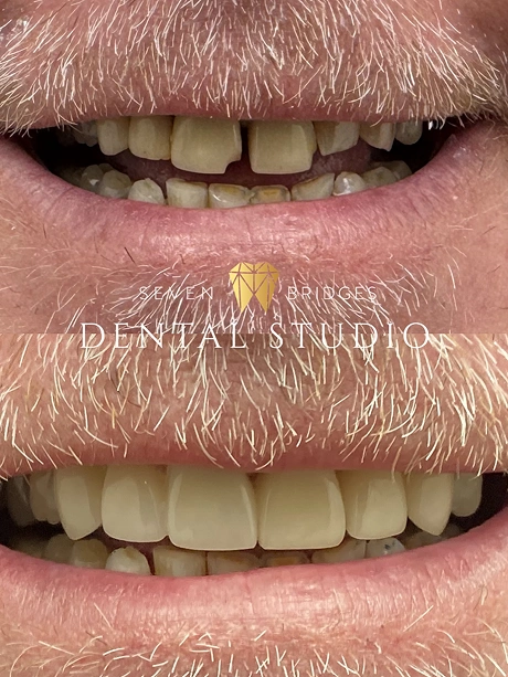 Before and after smile restoration highlighting improved dental function and aesthetics