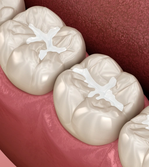 Dental Sealants