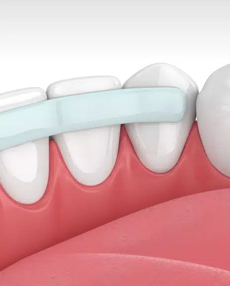 Dental Bonding