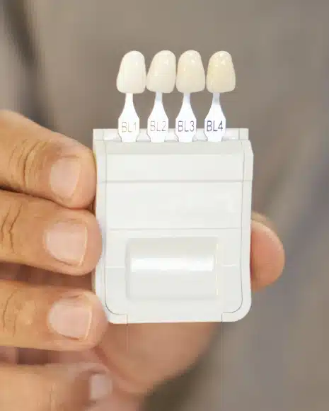 Dental Veneers