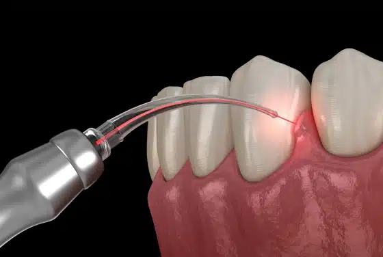 Soft Tissue Laser