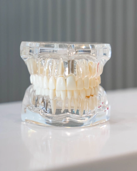 Dental Implants