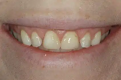 healthier smile by dentist arcadia - before