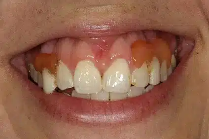 smile transformation by dentist arcadia - before