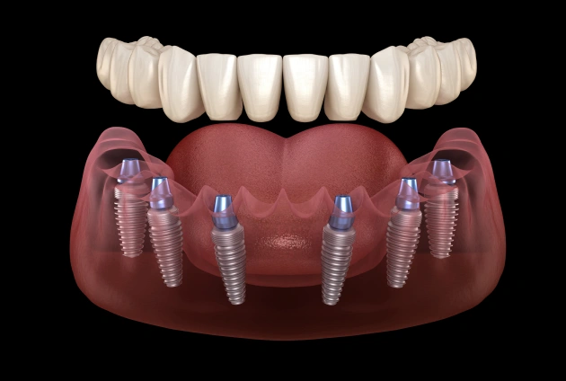 All‑on‑X Implants