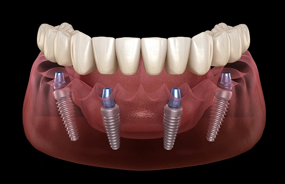 All‑on‑X Implants
