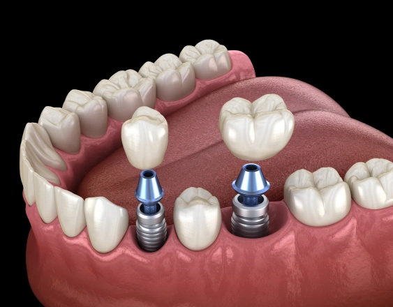 All‑on‑X Implants
