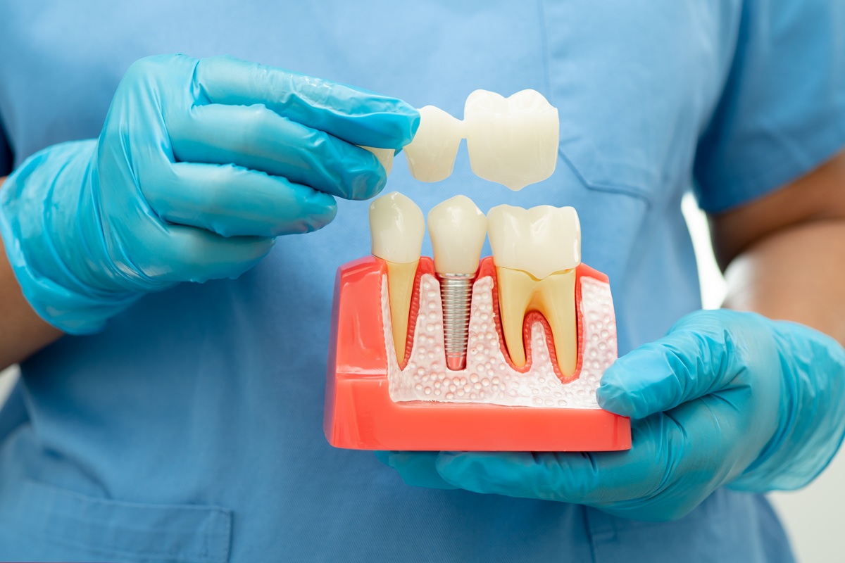 understanding all on x implant