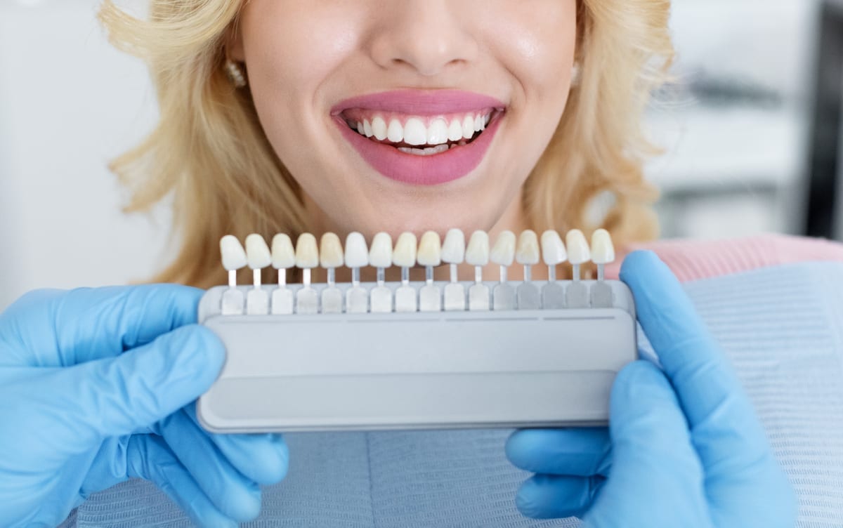 Veneers in Sierra Madre