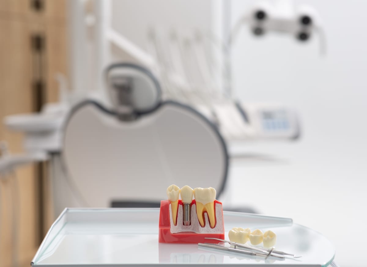 Dental Implants in Arcadia
