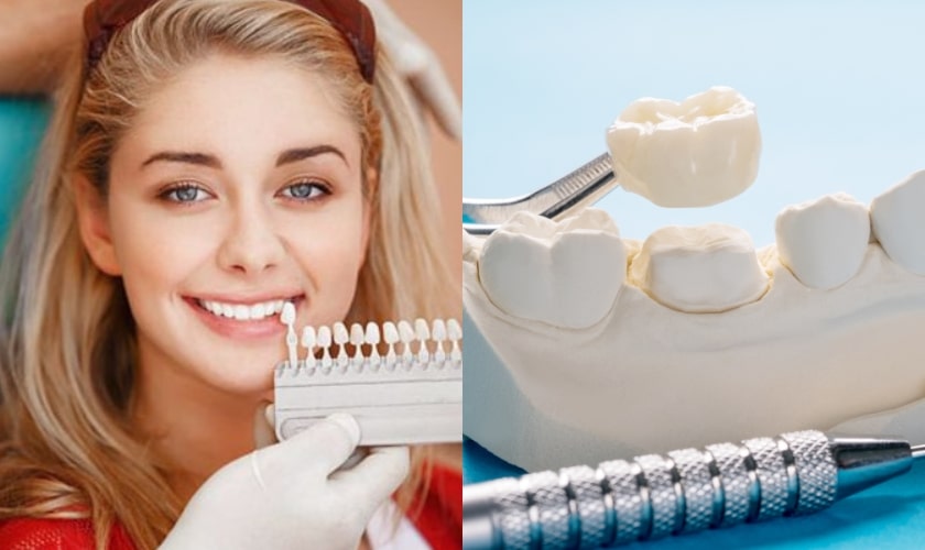 Veneers Vs. Crowns - Smile Studio Dental Denver