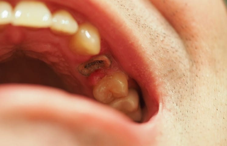 what happens if you leave a broken tooth root in your mouth