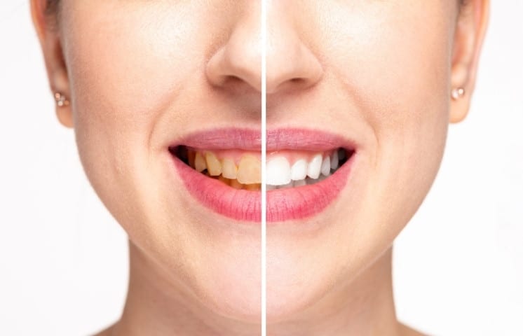 7 Foods That You Should Avoid After Teeth Whitening