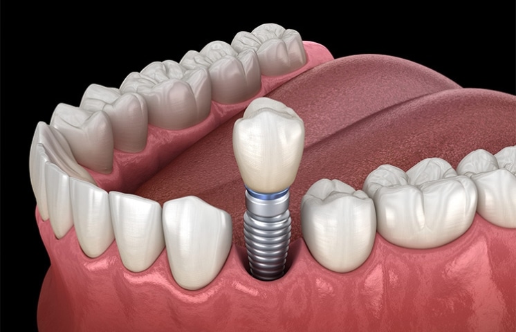 What is the best option for single tooth replacement