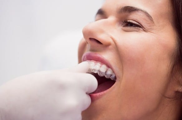 Invisalign