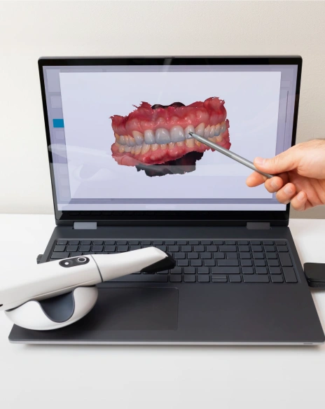 A hand using a stylus on a laptop screen showing a 3D digital dental scan of a patient's teeth, with a handheld intraoral scanner sitting next to the computer.