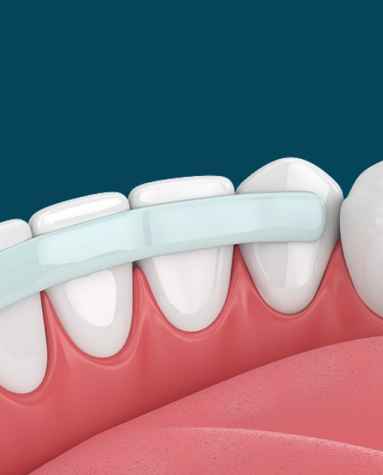 A 3D digital dental illustration showing a clear tooth-colored resin matrix template positioned against a row of front teeth.