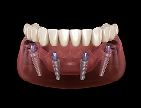 3D dental illustration of a full arch restoration, showing four dental implant posts strategically placed into a lower jaw model supporting a complete set of upper prosthetic teeth.