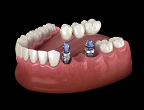3D dental model of a lower jaw demonstrating an implant-supported bridge, showing two dental implant posts anchored into the gums supporting a three-unit dental bridge to replace multiple missing teeth.