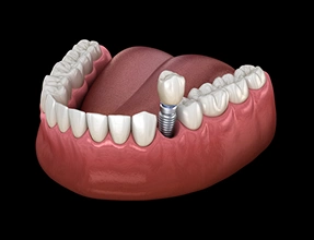 3D dental illustration of a full arch restoration, showing four dental implant posts strategically placed into a lower jaw model supporting a complete set of upper prosthetic teeth.