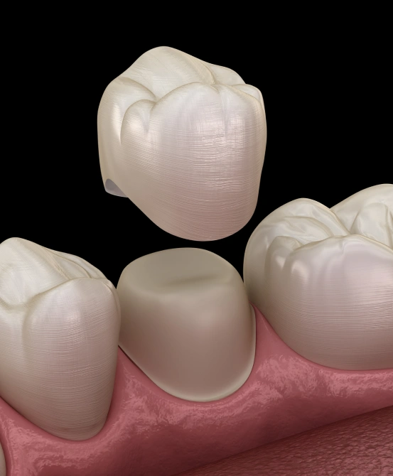Close-up 3D medical illustration of a white ceramic permanent dental crown being placed over a tooth.