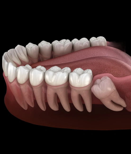 3D digital illustration of a lower jaw showing an impacted wisdom tooth growing sideways beneath the gumline.