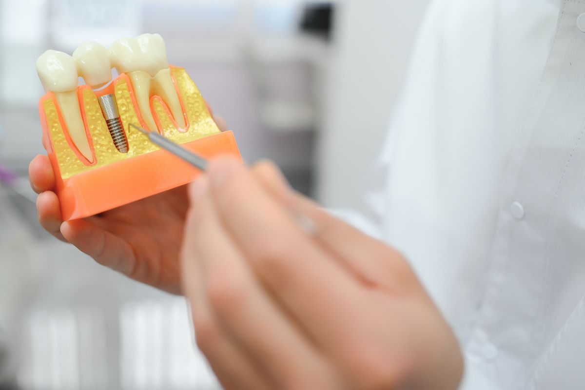 The Ultimate Guide to Dental Implants