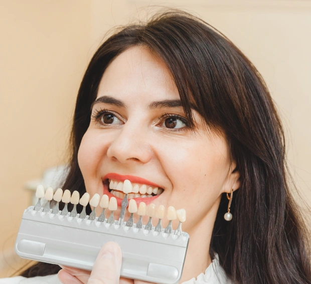 what are veneers