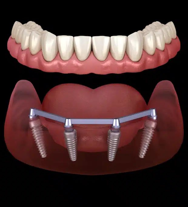 all on-x-dental implants in pittsburgh, pa
