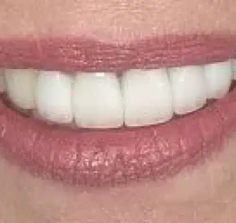 After treatment