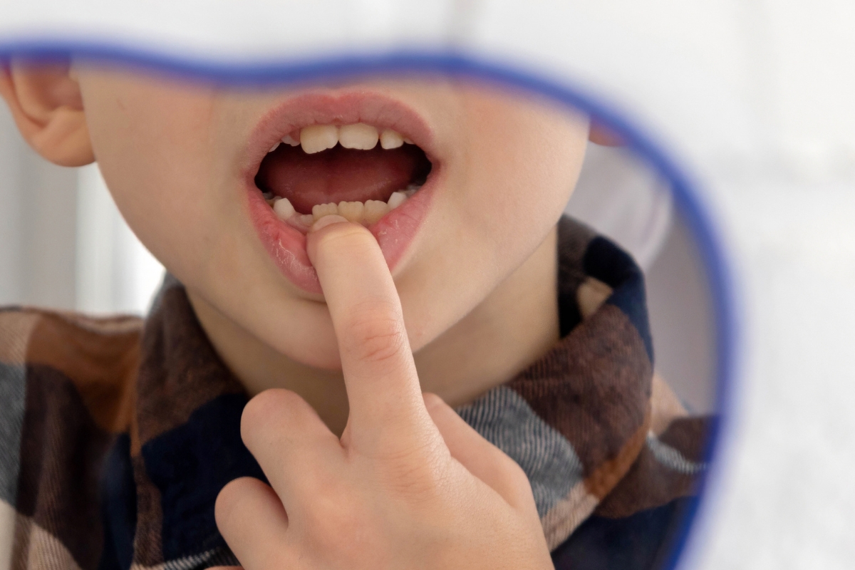orthodontic-treatment-in-spanaway-WA