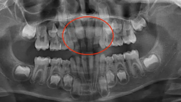 img-Early-or-Interceptive-Treatment-pic-11
