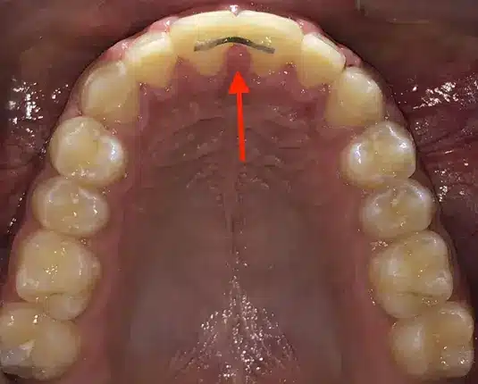 img Fixed Retainers (Bonded Retainers) 1