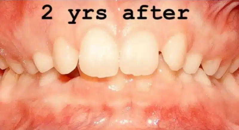 img-braces-for-kids-after 1