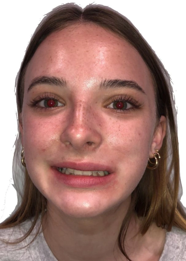 Avery - Teen omprehensive orthodontic treatment before