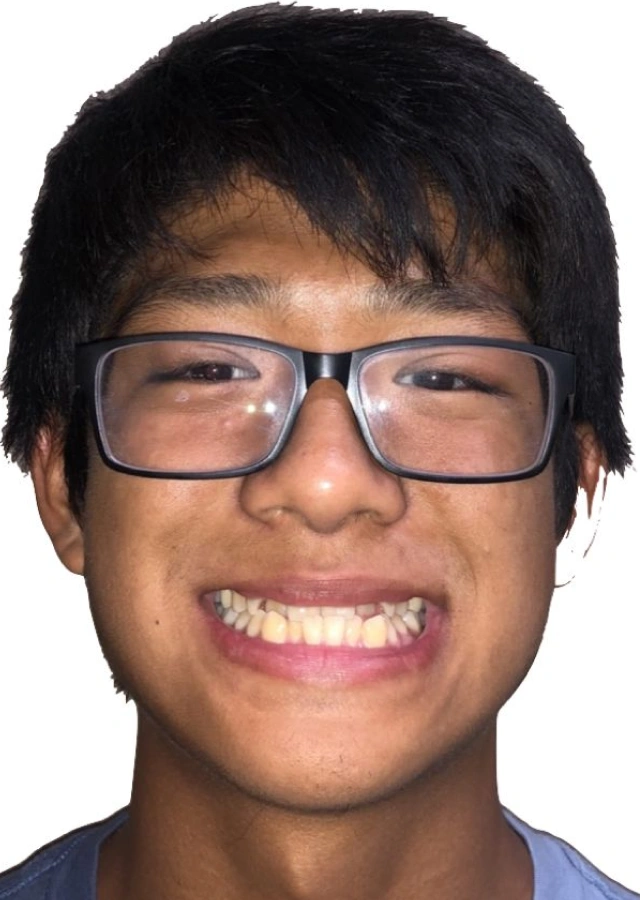 Samuel - Teen omprehensive orthodontic treatment before