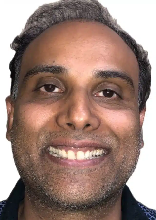 Sreenivasa - Adult comprehensive orthodontic treatment before