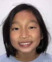 Victoria — Después de Invisalign First