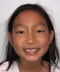 Victoria — Antes de Invisalign First