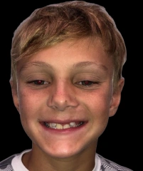 Casen — Antes