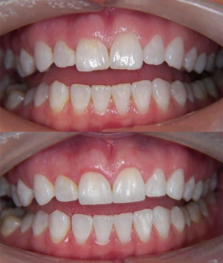 Before & After